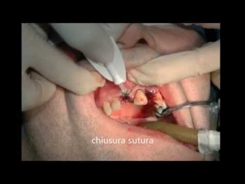Colla Innovativa per Tagli Profondi