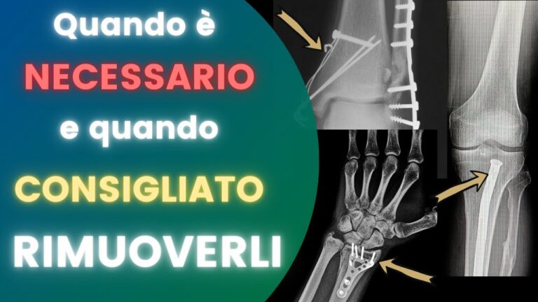 Costo del ticket per rimozione gesso: tutto quello che devi sapere